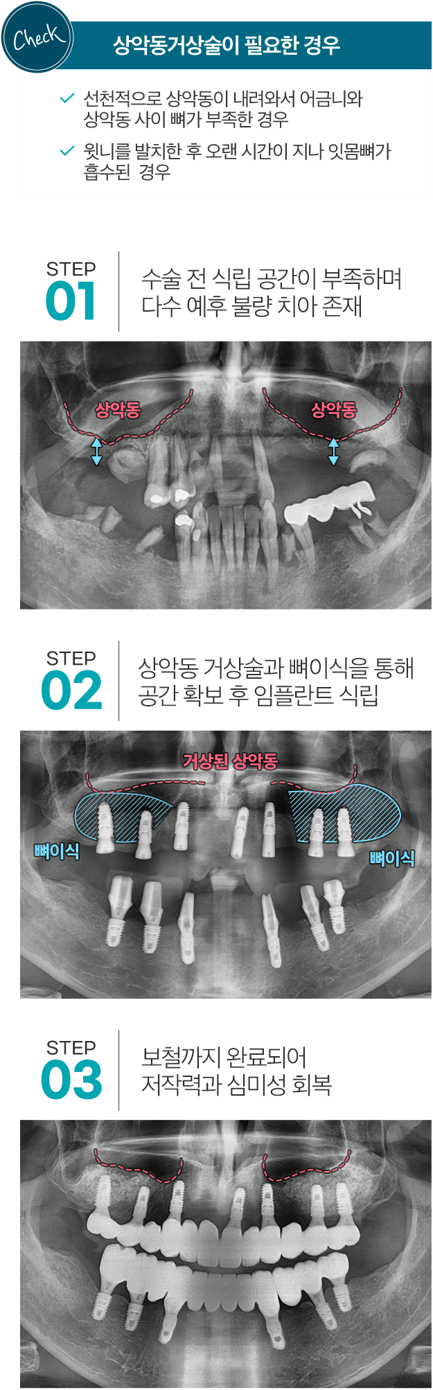 Check 상악동거상술이 필요한 경우 - 선천적으로 상악동이 내려와서 어금니와 상악동 사이 뼈가 부족한 경우 , 윗니를 발치한 후 오랜 시간이 지나 잇몸뼈가 흡수된 경우. STEP 01 수술 전 식립 공간이 부족하며 다수 예후 불량 치아 존재. STEP 02 상악동 거상술과 뼈이식을 통해 공간 확보 후 임플란트 식립. STEP 03 보철까지 완료되어 저작력과 심미성 회복