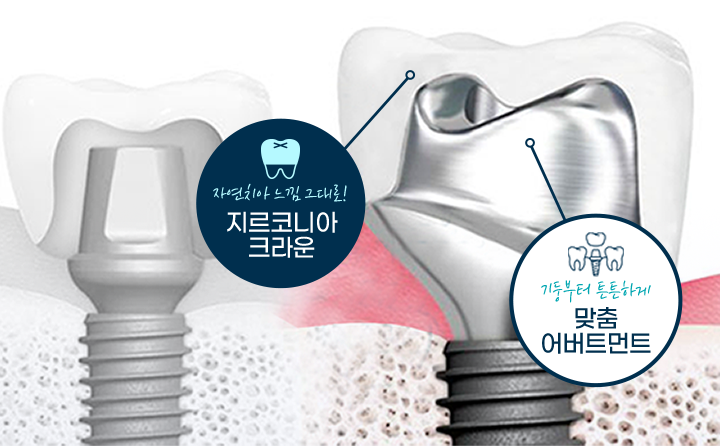 자연치아 느낌 그대로! 지르코니아 크라운 / 기둥부터 튼튼하게 맞춤 어버트먼트