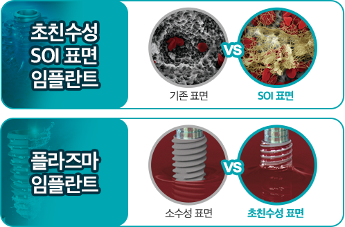 초친수성 SOI 표면 임플란트 - 기존 표면 VS SOI 표면 / 플라즈마 임플란트 - 소수성 표면 VS 초친수성 표면