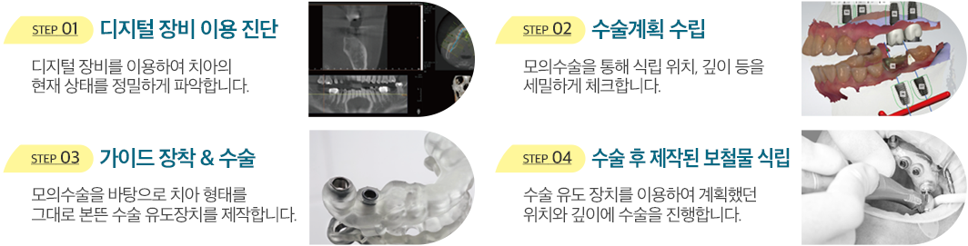 STEP 01 디지털 장비 이용 진단 - 디지털 장비를 이용하여 치아의 현재 상태를 정밀하게 파악합니다. STEP 02 수술계획 수립 - 모의수술을 통해 식립 위치, 깊이 등을 세밀하게 체크합니다. STEP 03 가이드 장착 & 수술 - 모의수술을 바탕으로 치아 형태를 그대로 본뜬 수술 유도장치를 제작합니다. STEP 04 수술 후 제작된 보철물 식립 - 수술 유도 장치를 이용하여 계획했던 위치와 깊이에 수술을 진행합니다.