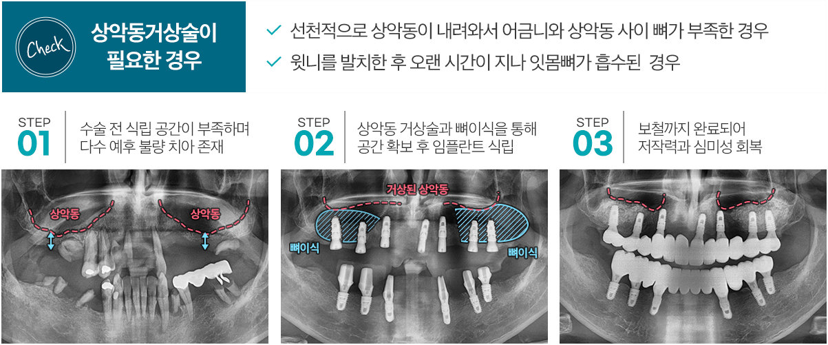 Check 상악동거상술이 필요한 경우 - 선천적으로 상악동이 내려와서 어금니와 상악동 사이 뼈가 부족한 경우 , 윗니를 발치한 후 오랜 시간이 지나 잇몸뼈가 흡수된 경우. STEP 01 수술 전 식립 공간이 부족하며 다수 예후 불량 치아 존재. STEP 02 상악동 거상술과 뼈이식을 통해 공간 확보 후 임플란트 식립. STEP 03 보철까지 완료되어 저작력과 심미성 회복