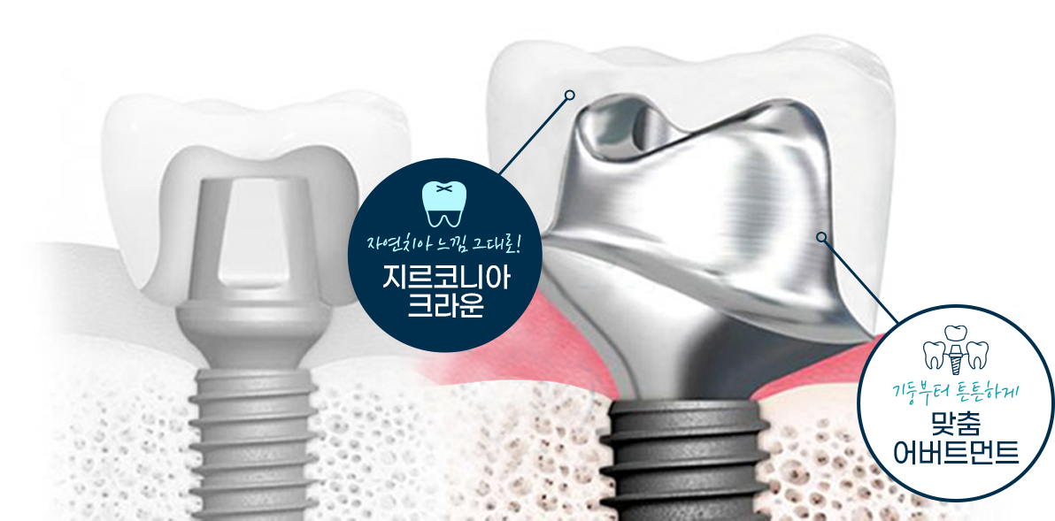 자연치아 느낌 그대로! 지르코니아 크라운 / 기둥부터 튼튼하게 맞춤 어버트먼트