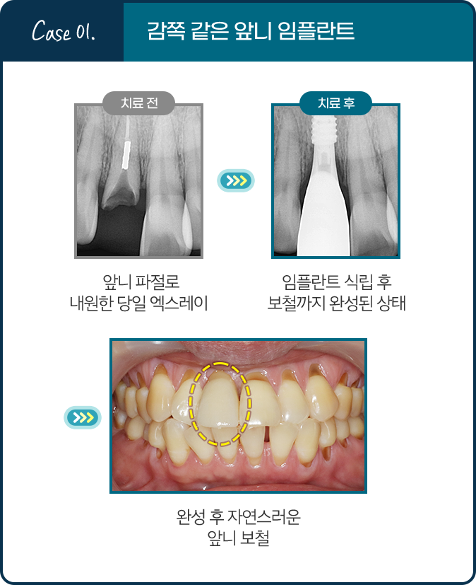 Case 01. 감쪽 같은 앞니 임플란트 - 치료 전: 앞니 파절로 내원한 당일 엑스레이 / 치료 후: 임플란트 식립 후 보철까지 완성된 상태 / 완성 후 자연스러운 앞니 보철