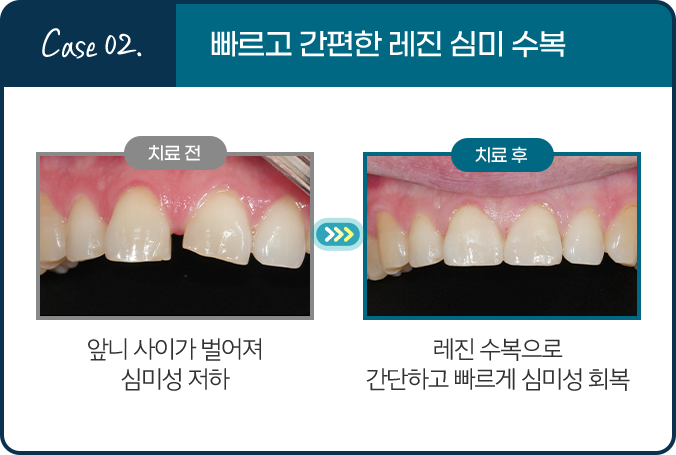 Case 02. 빠르고 간편한 레진 심미 수복 - 치료 전: 앞니 사이가 벌어져 심미성 저하 / 치료 후: 레진 수복으로 간단하고 빠르게 심미성 회복