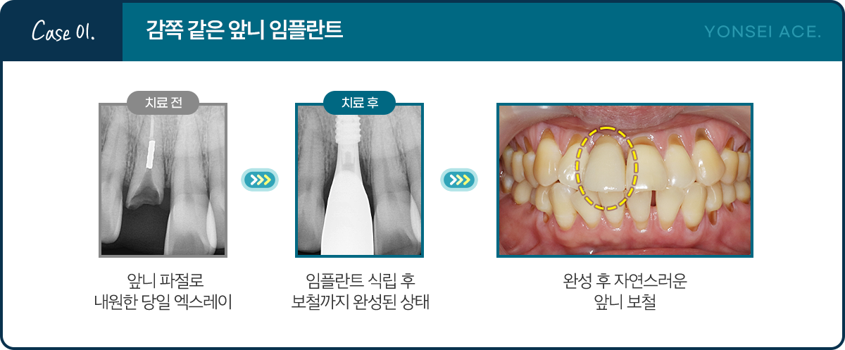 Case 01. 감쪽 같은 앞니 임플란트 - 치료 전: 앞니 파절로 내원한 당일 엑스레이 / 치료 후: 임플란트 식립 후 보철까지 완성된 상태 / 완성 후 자연스러운 앞니 보철