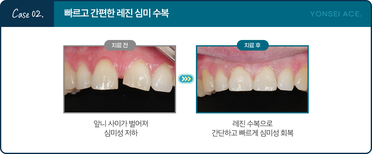 Case 02. 빠르고 간편한 레진 심미 수복 - 치료 전: 앞니 사이가 벌어져 심미성 저하 / 치료 후: 레진 수복으로 간단하고 빠르게 심미성 회복