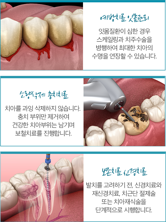 예방치료 잇몸관리 / 소량삭제 충치치료 / 보존치료 신경치료