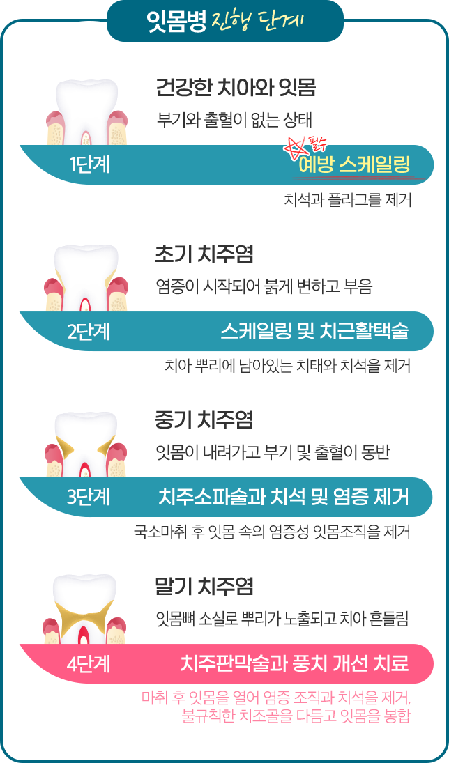 1단계 건강한 치아와 잇몸 - 예방 스케일링 / 2단계 초기 치주염 - 스케일링 및 치근활택술 / 3단계 중기 치주염 - 치주소파술과 치석 및 염증 제거 / 4단계 말기 치주염 - 치주판막술과 풍치 개선 치료