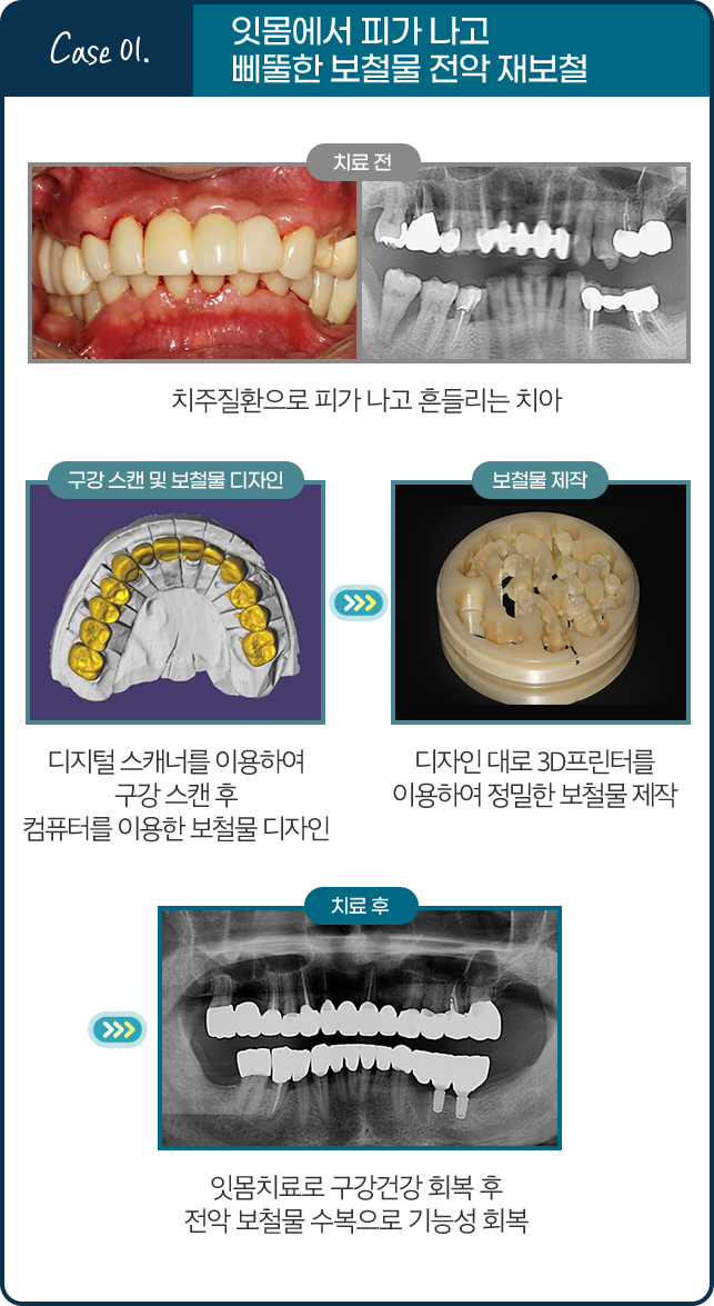 Case 01. 잇몸에서 피가 나고 삐뚤한 보철물 전악 재보철