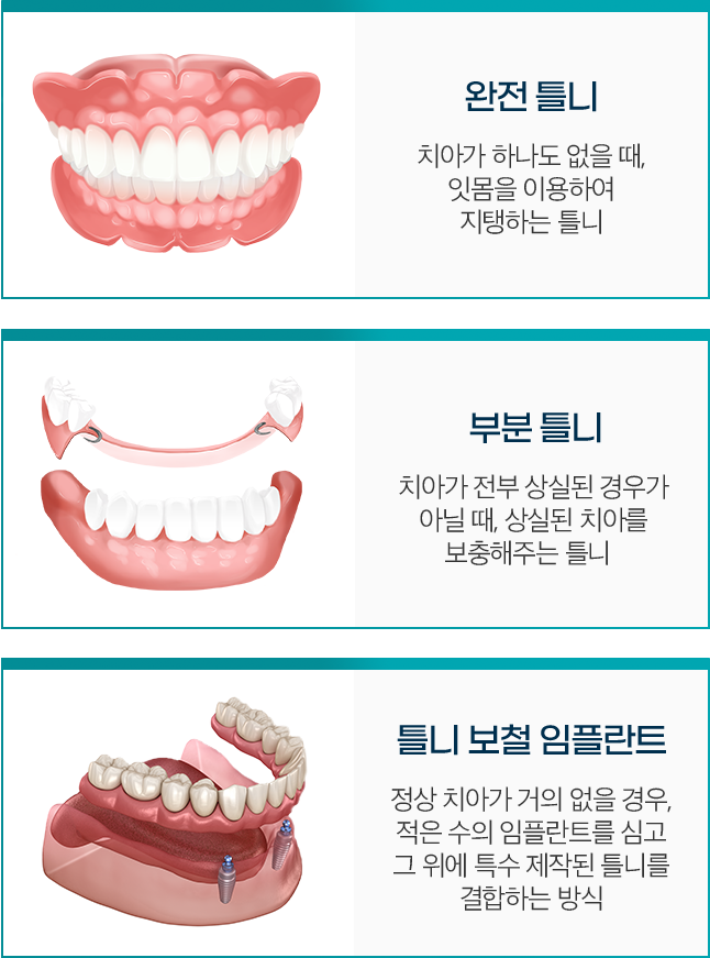 완전 틀니 / 부분 틀니 / 틀니 보철 임플란트