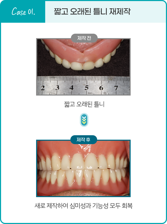 Case 01. 짧고 오래된 틀니 재제작
