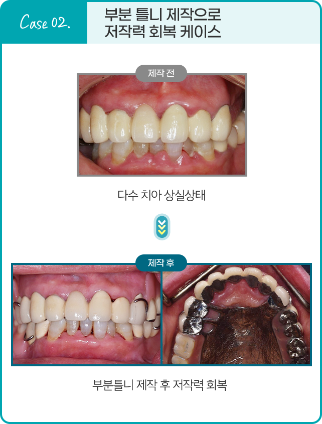 Case 02. 부분 틀니 제작으로 저작력 회복 케이스