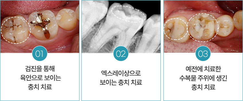 01 검진을 통해 육안으로 보이는 충치 치료 / 02 엑스레이상으로 보이는 충치 치료 / 03 예전에 치료한 수복물 주위에 생긴 충치 치료