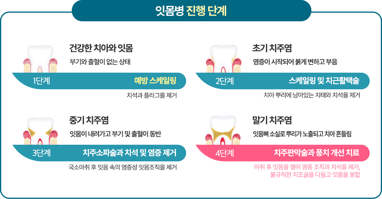 1단계 건강한 치아와 잇몸 - 예방 스케일링 / 2단계 초기 치주염 - 스케일링 및 치근활택술 / 3단계 중기 치주염 - 치주소파술과 치석 및 염증 제거 / 4단계 말기 치주염 - 치주판막술과 풍치 개선 치료
