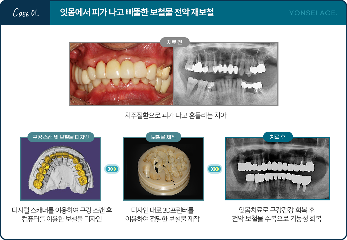 Case 01. 잇몸에서 피가 나고 삐뚤한 보철물 전악 재보철