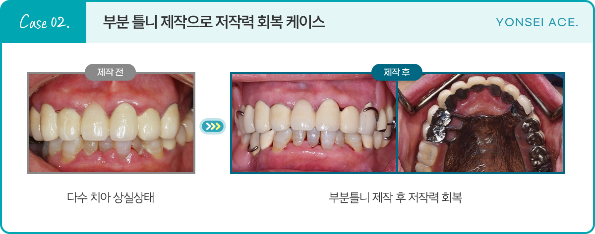 Case 02. 부분 틀니 제작으로 저작력 회복 케이스